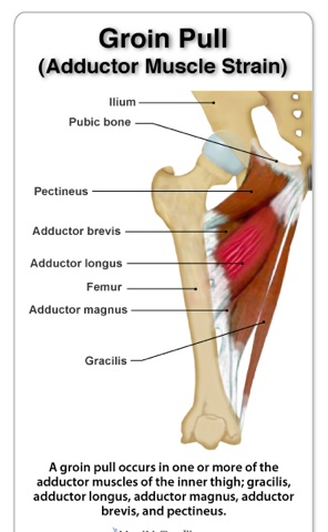 Groin and Adductor Strains In Ultimate Players: Why It Happens And What
